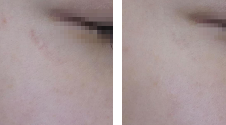 Pico Laser Skin Resurfacing