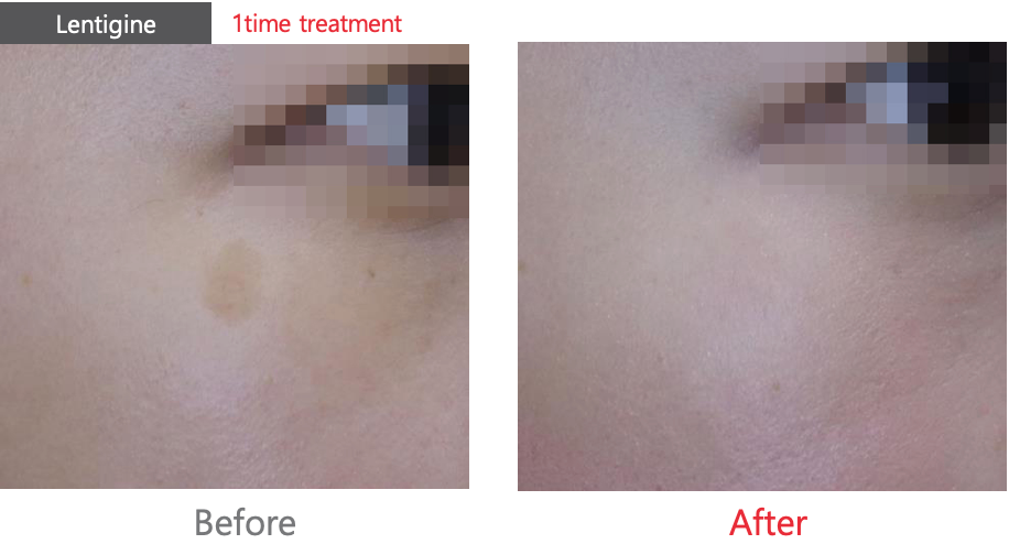 Pico Laser Skin Resurfacing