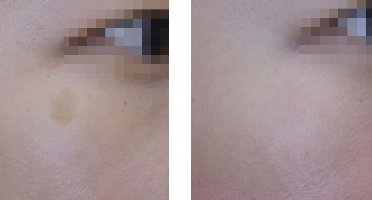 Pico Laser Skin Resurfacing