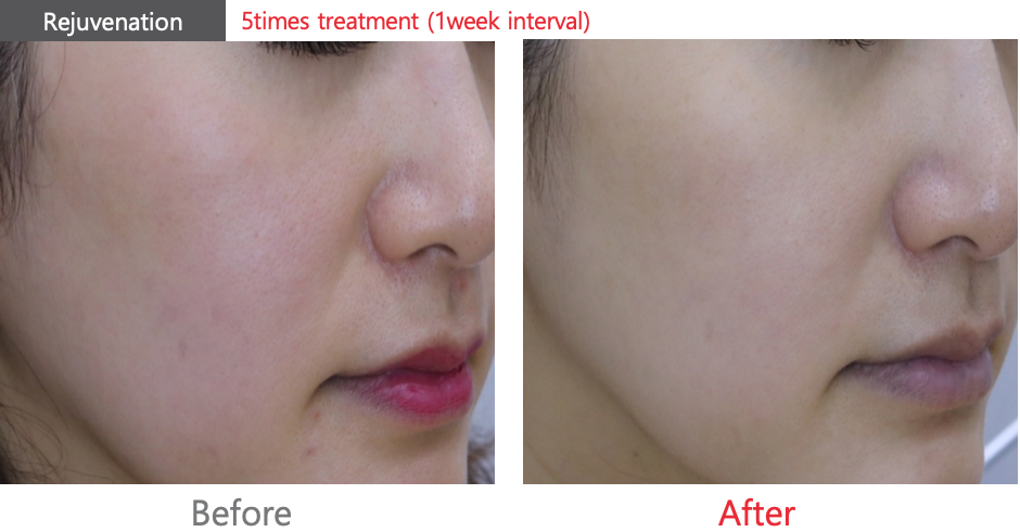 Pico Laser Skin Resurfacing
