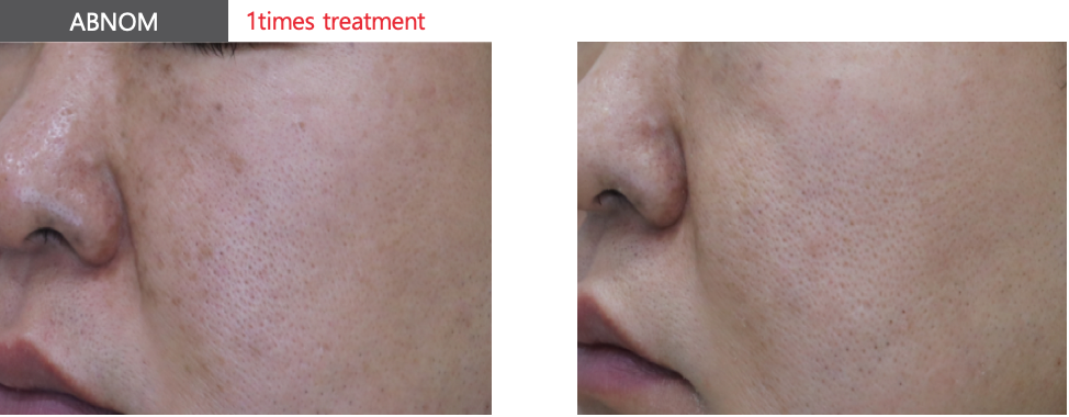 Pico Laser Skin Resurfacing