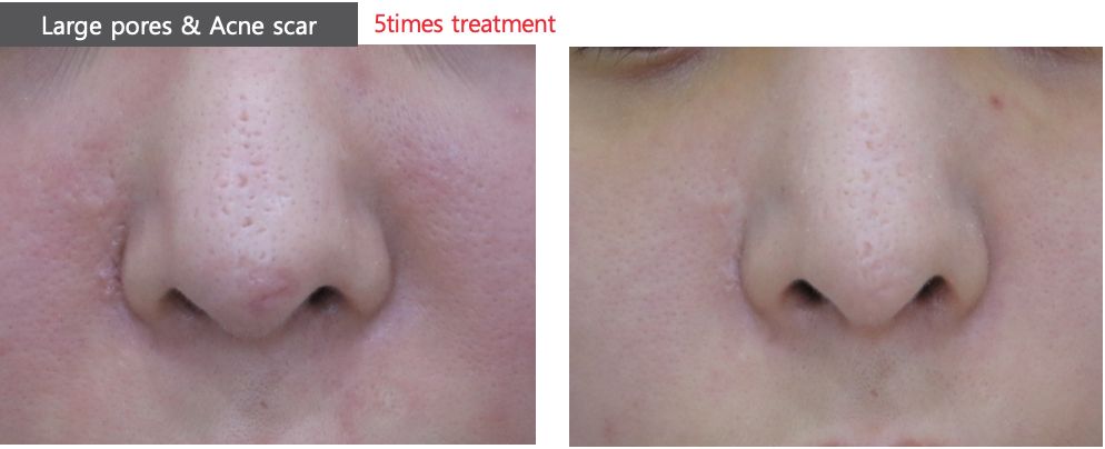 Pico Laser Skin Resurfacing
