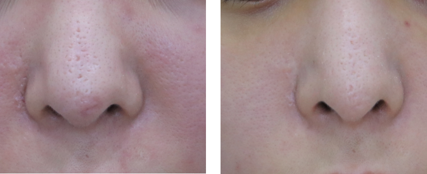 Pico Laser Skin Resurfacing