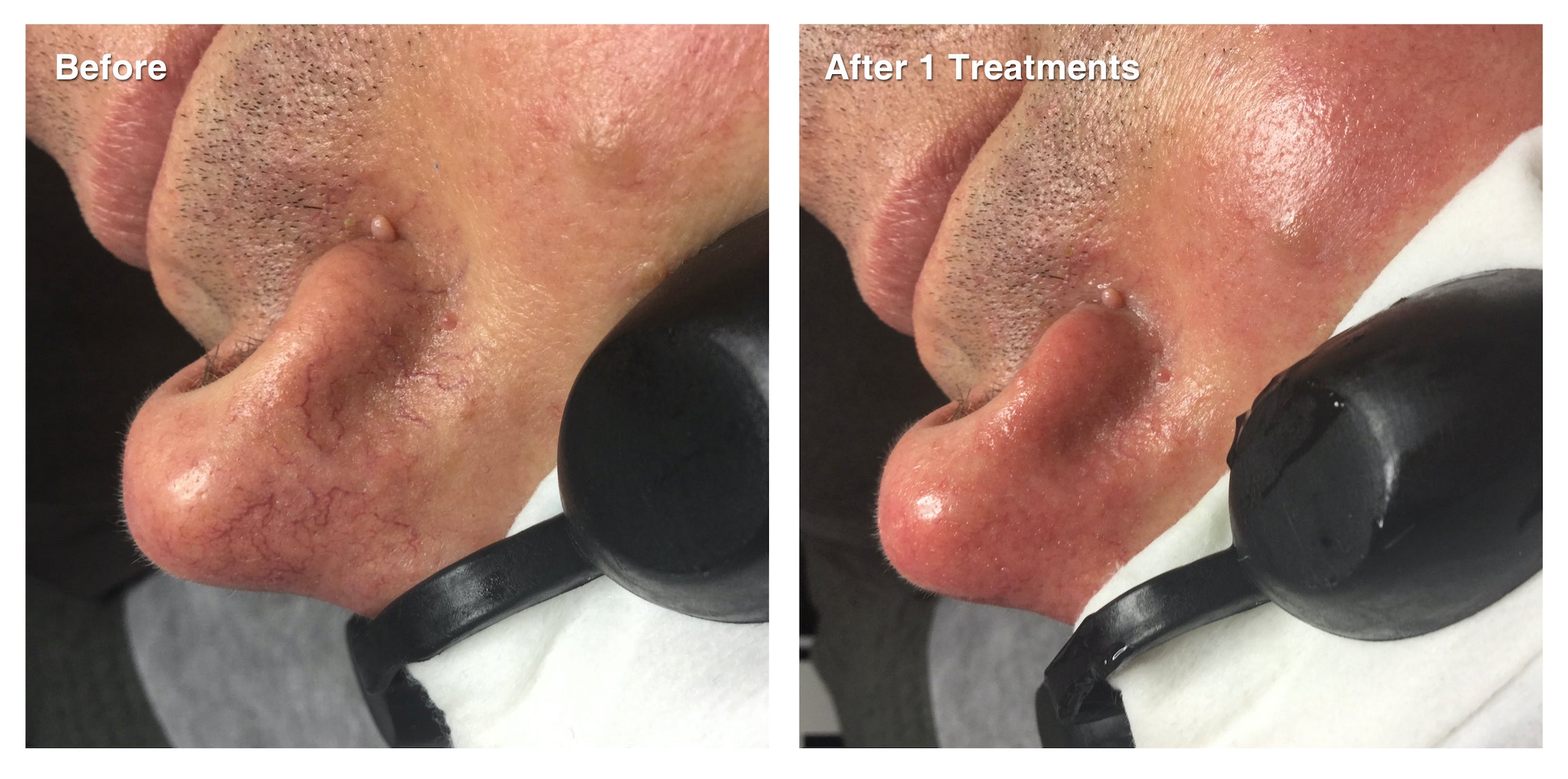 IPL Photo Rejuvenation