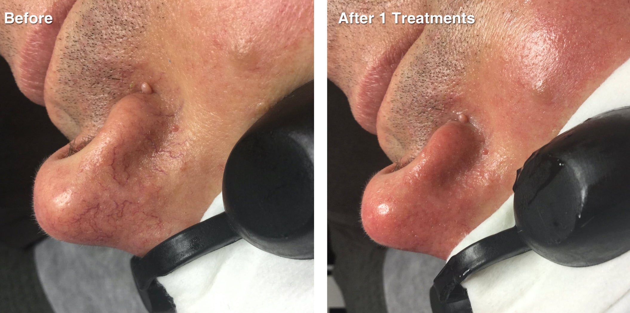 IPL Photo Rejuvenation