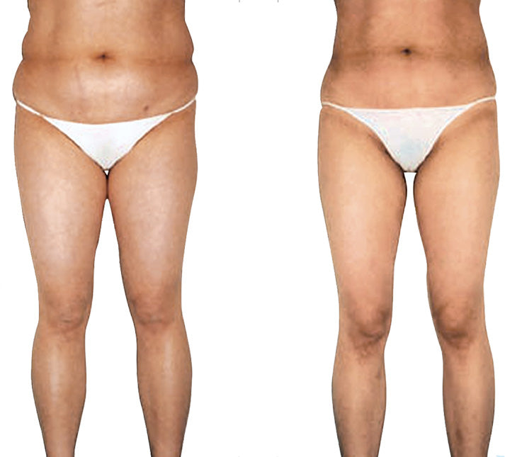 Endermologie Body Contouring