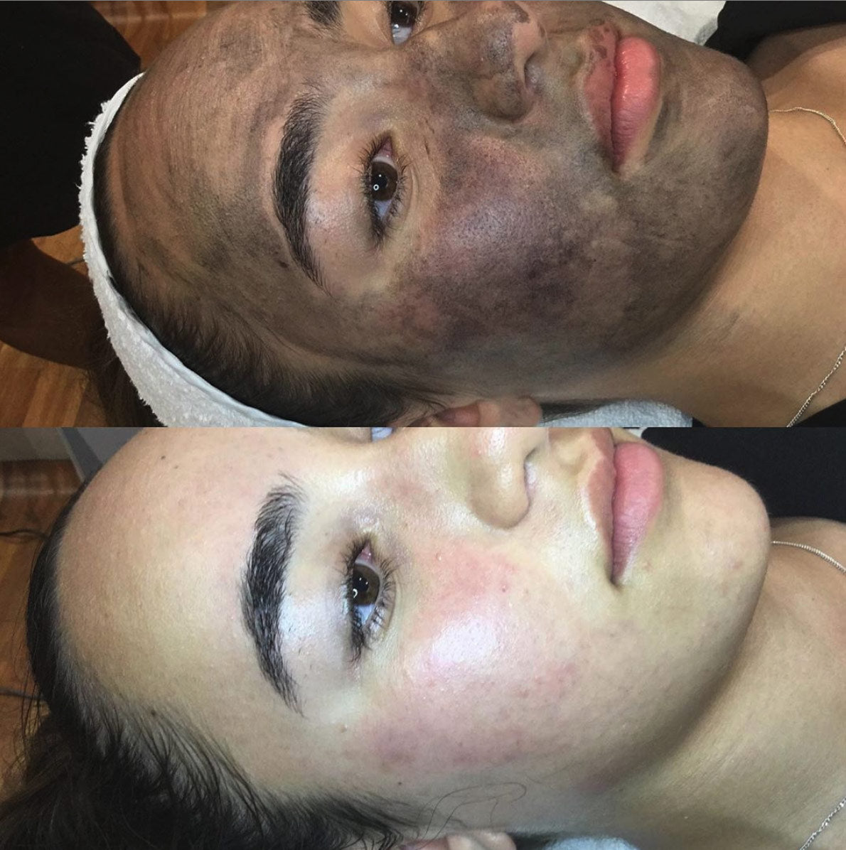 Carbon Laser Facial (China Doll)