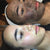 Carbon Laser Facial (China Doll)