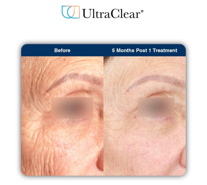 UltraClear vs CO2 Laser: Which Treatment Is Right for Your Skin?