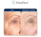 UltraClear vs CO2 Laser: Which Treatment Is Right for Your Skin?