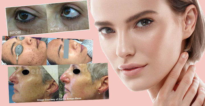 Skin Needling or Laser Resurfacing: How to Choose the Right Treatment for Your Skin