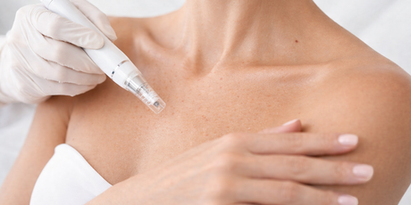 Add On: Hands / Décolletage – Skin Needling