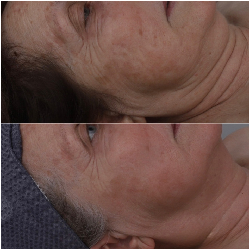 Ultraformer MPT Face & Neck Lift