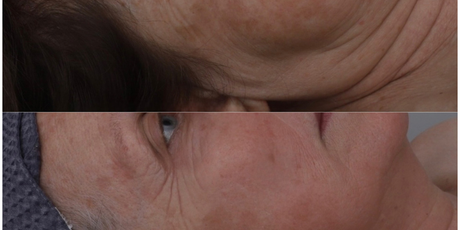 Ultraformer MPT Face & Neck Lift