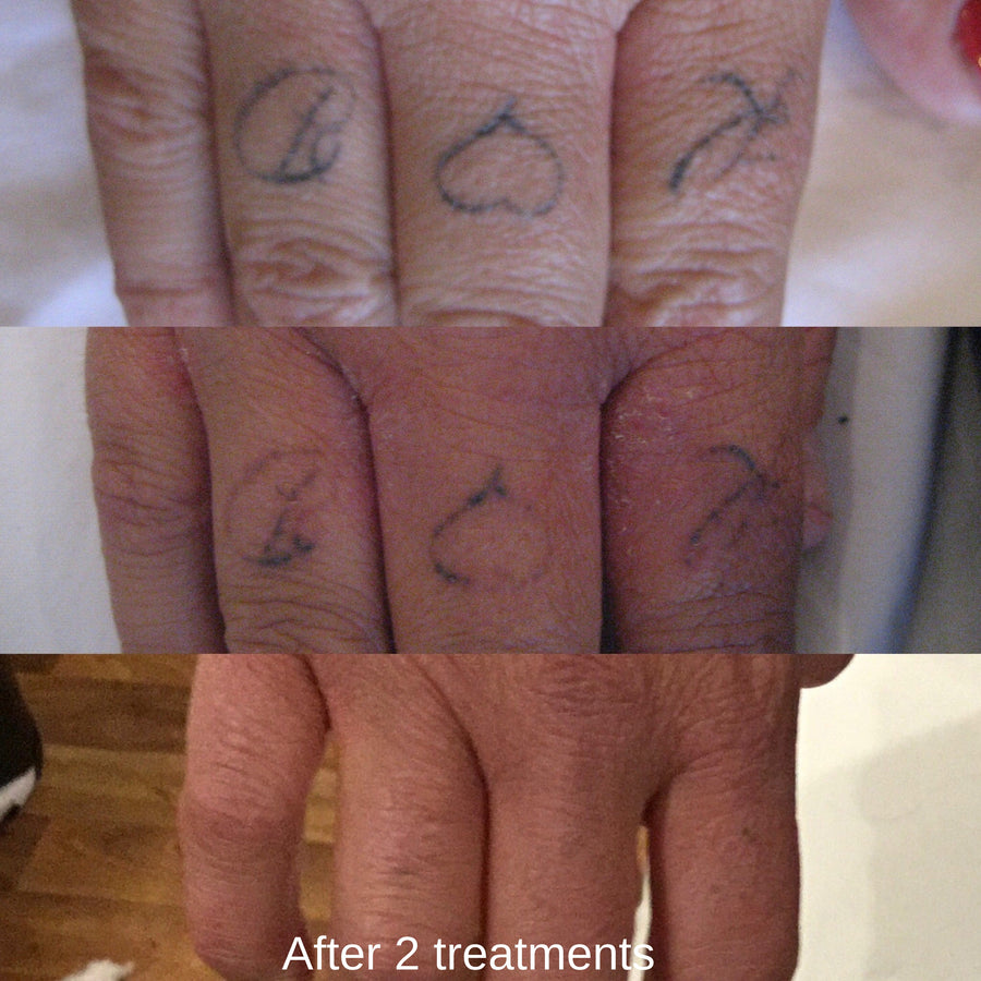 Pico laser tattoo removal