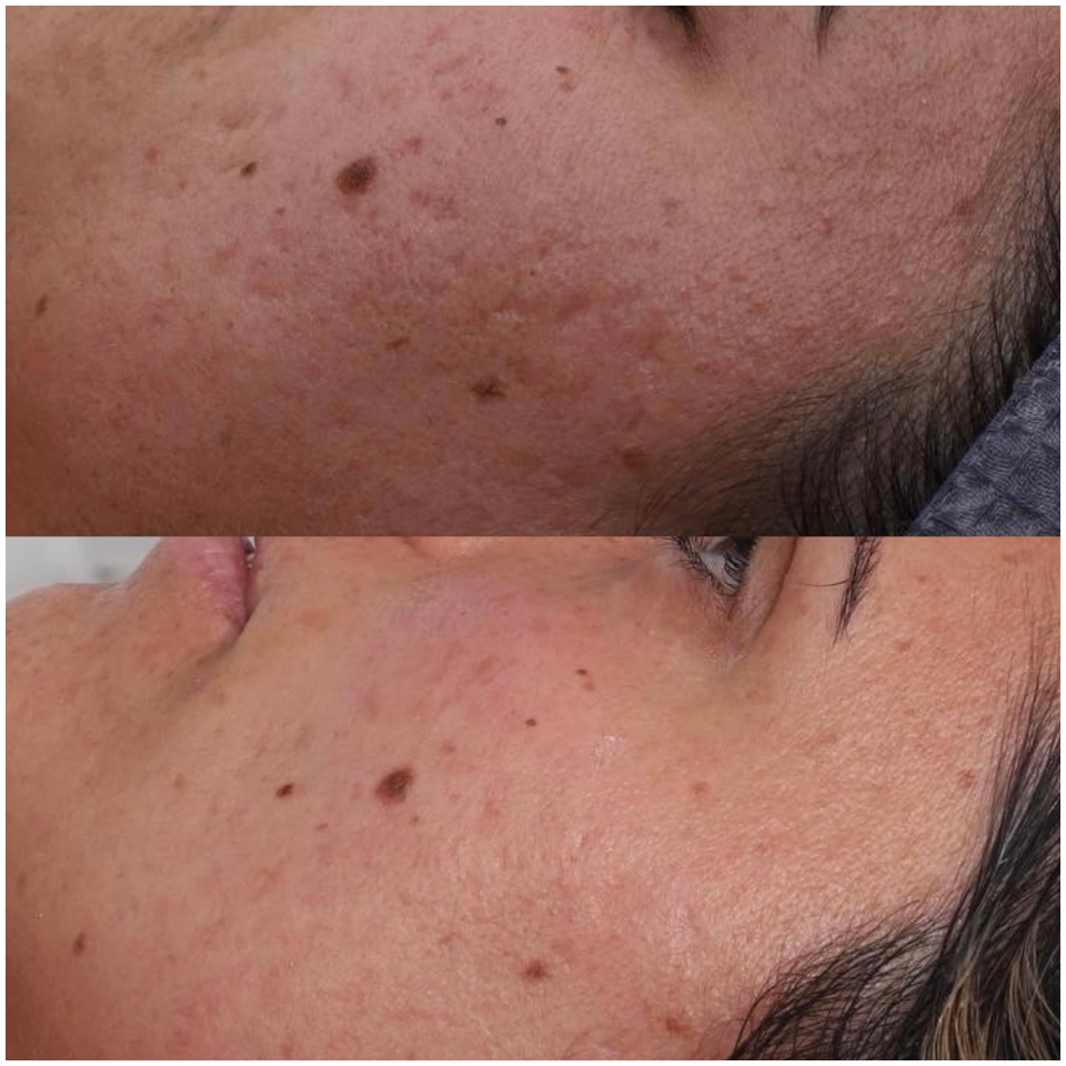 LEVEL 2 SKIN NEEDLING – Prepay 3 Get 4th Free