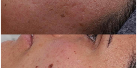 LEVEL 2 SKIN NEEDLING – Prepay 3 Get 4th Free