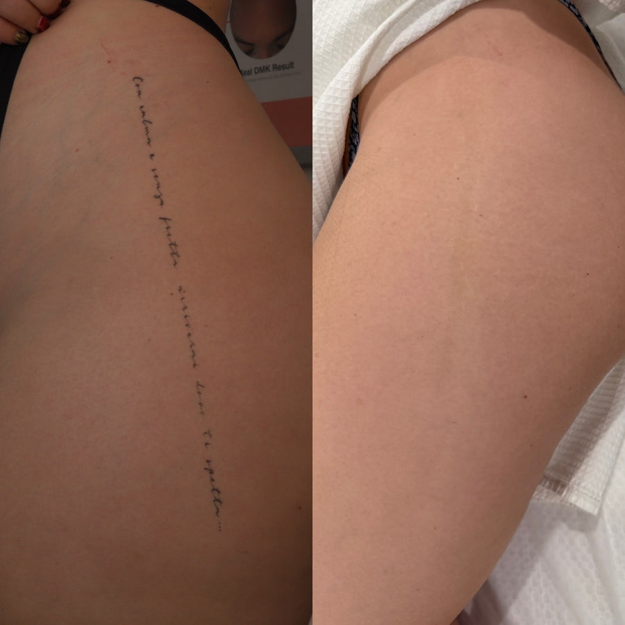 Pico laser tattoo removal