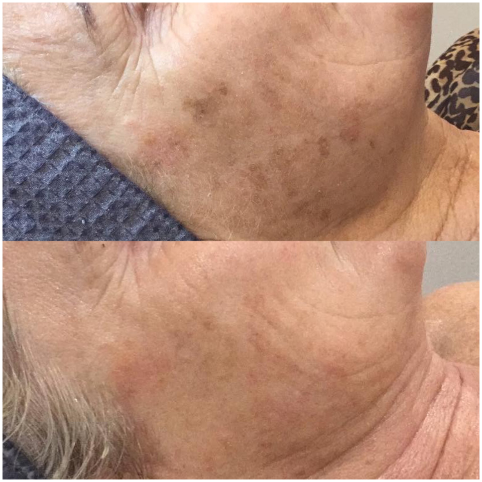 Radiance Revival - Pico Laser + Firming Peptide + LED