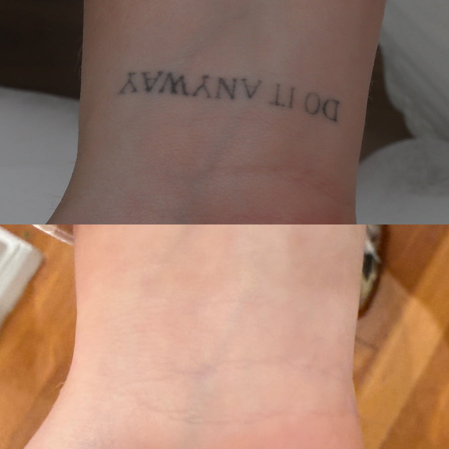 Pico laser tattoo removal
