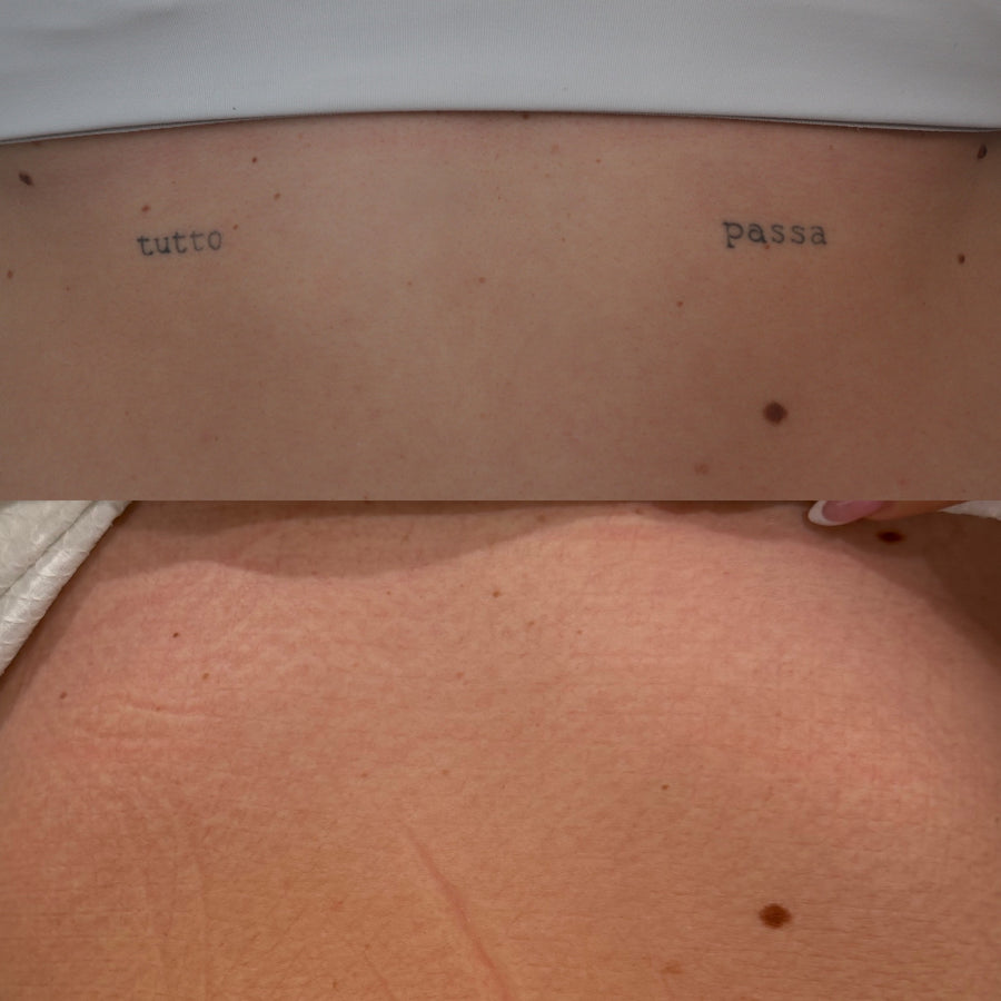 Pico laser tattoo removal