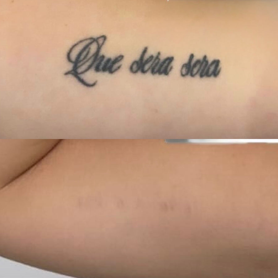 Pico laser tattoo removal