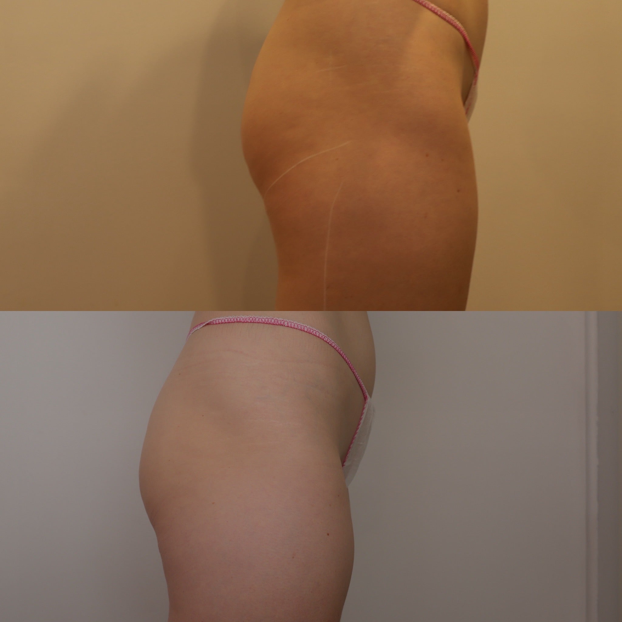 Brazilian Butt Lift