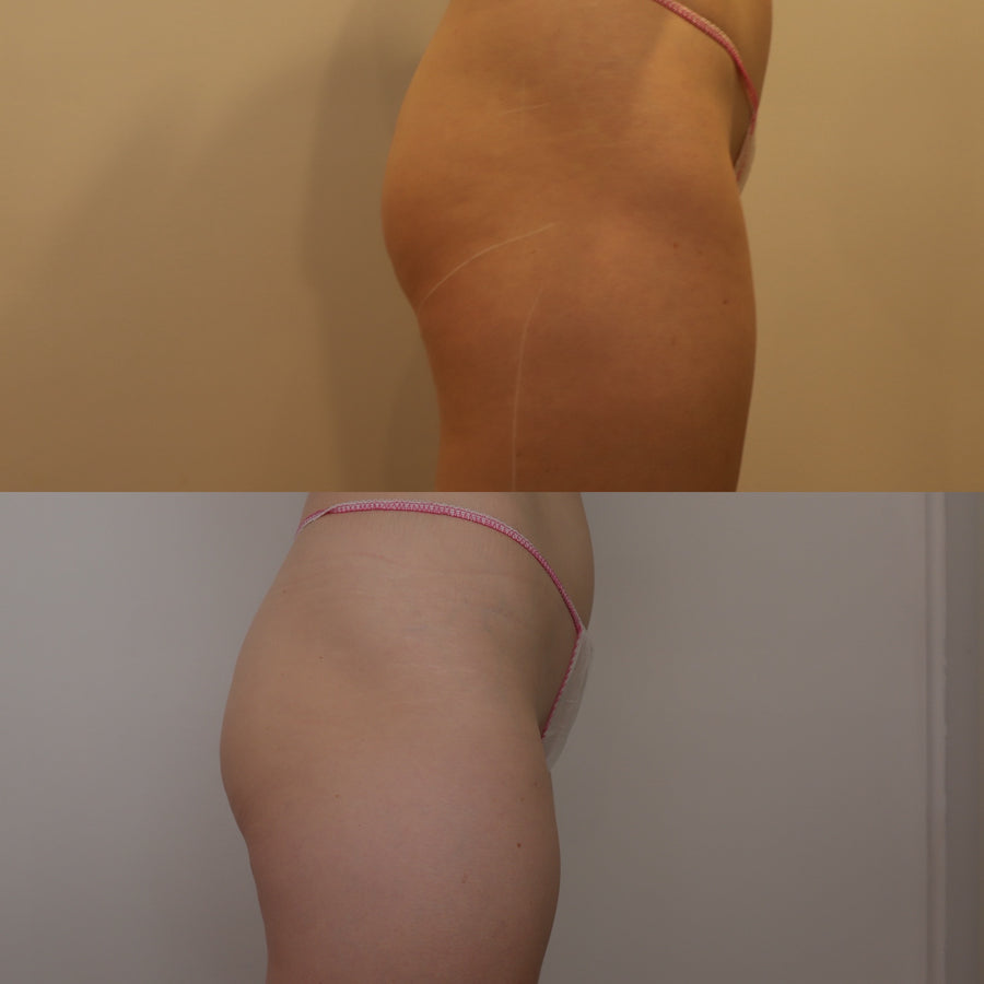 Endermologie