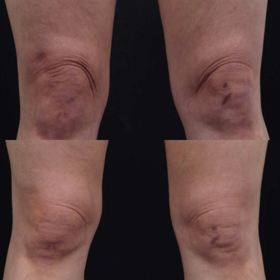 Ultraformer MPT HIFU for Body
