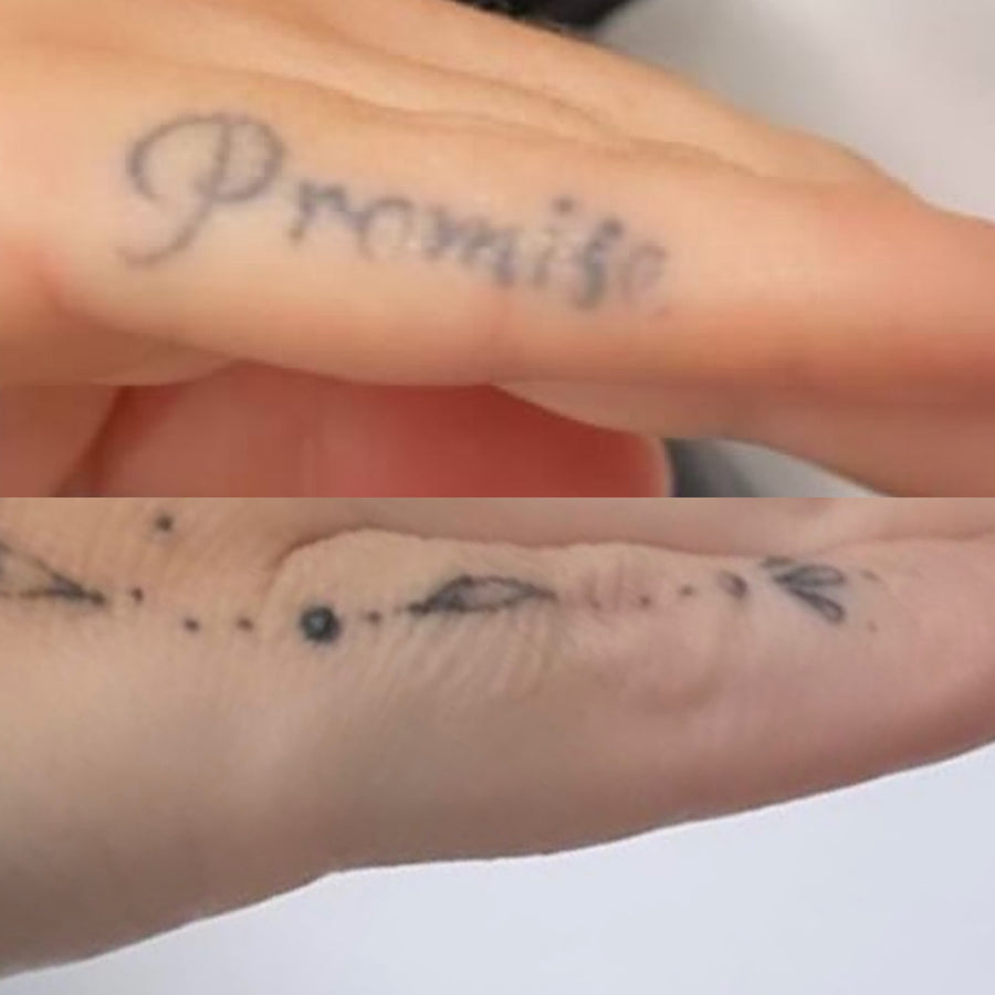 Pico laser tattoo removal