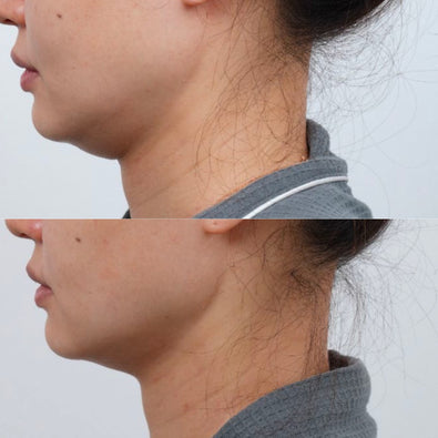 Jawline Definition