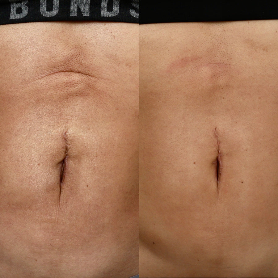 RF Skin Tightening for Body