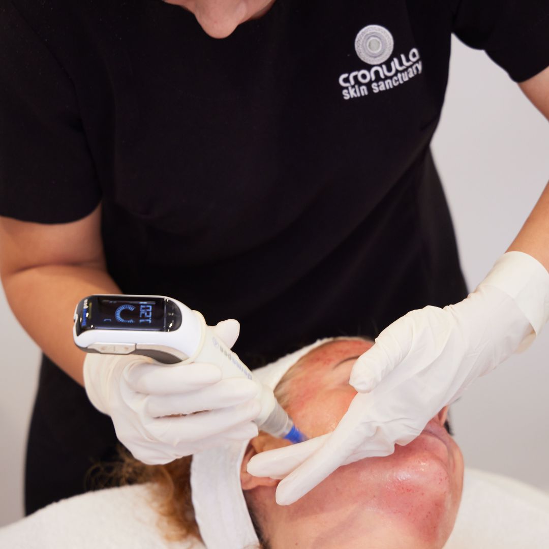 Level 4 Skin Needling with Exosomes