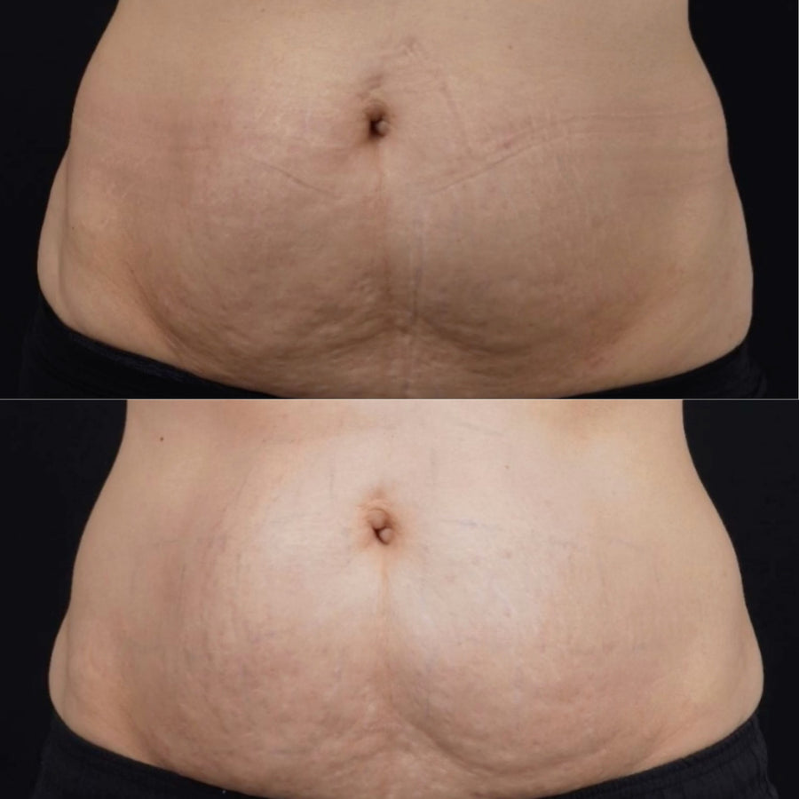 Ultraformer MPT HIFU for Body