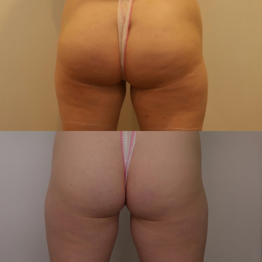 Endermologie