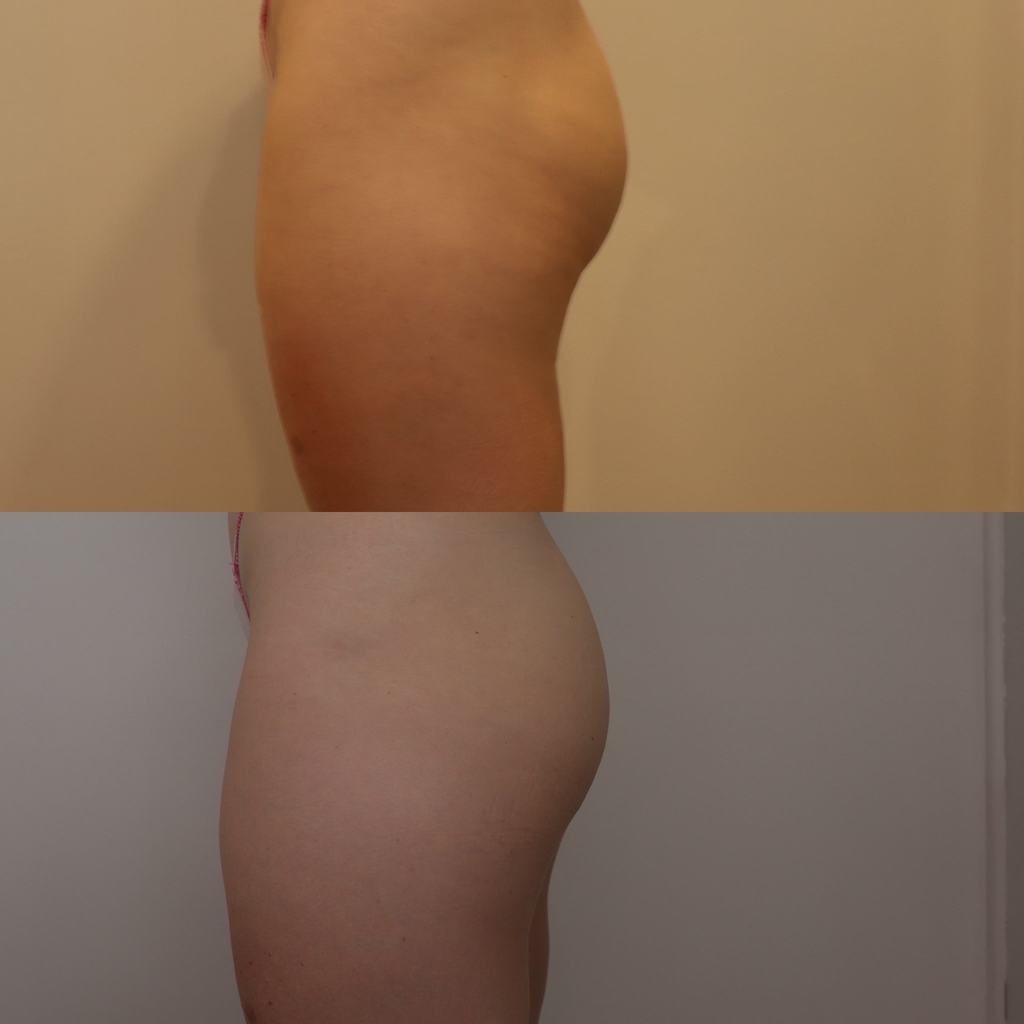 Brazilian Butt Lift
