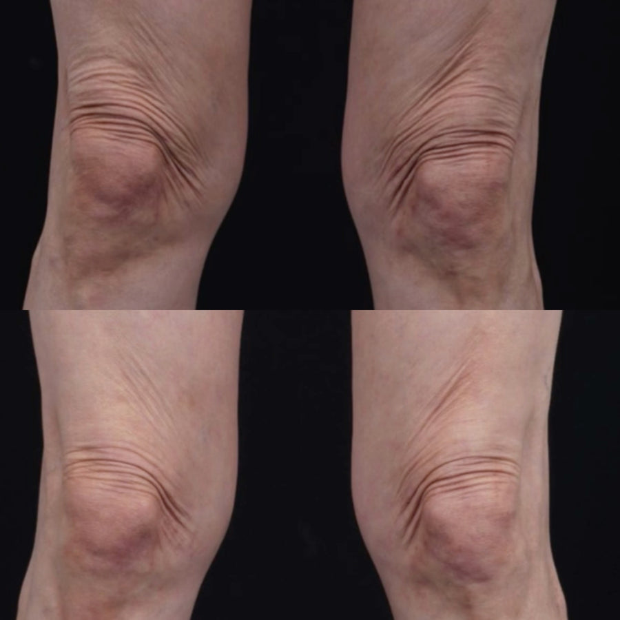 Ultraformer MPT HIFU for Body
