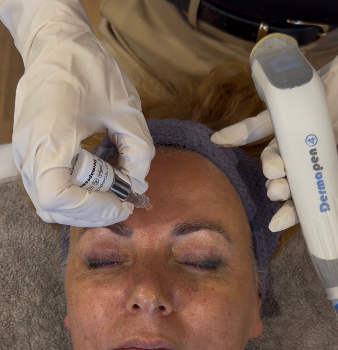 Skin Needling with Exosomes