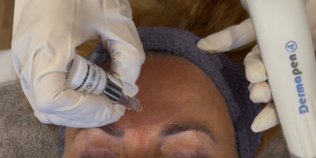 Skin Needling with Exosomes