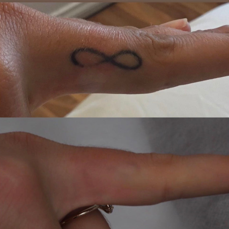 Pico laser tattoo removal
