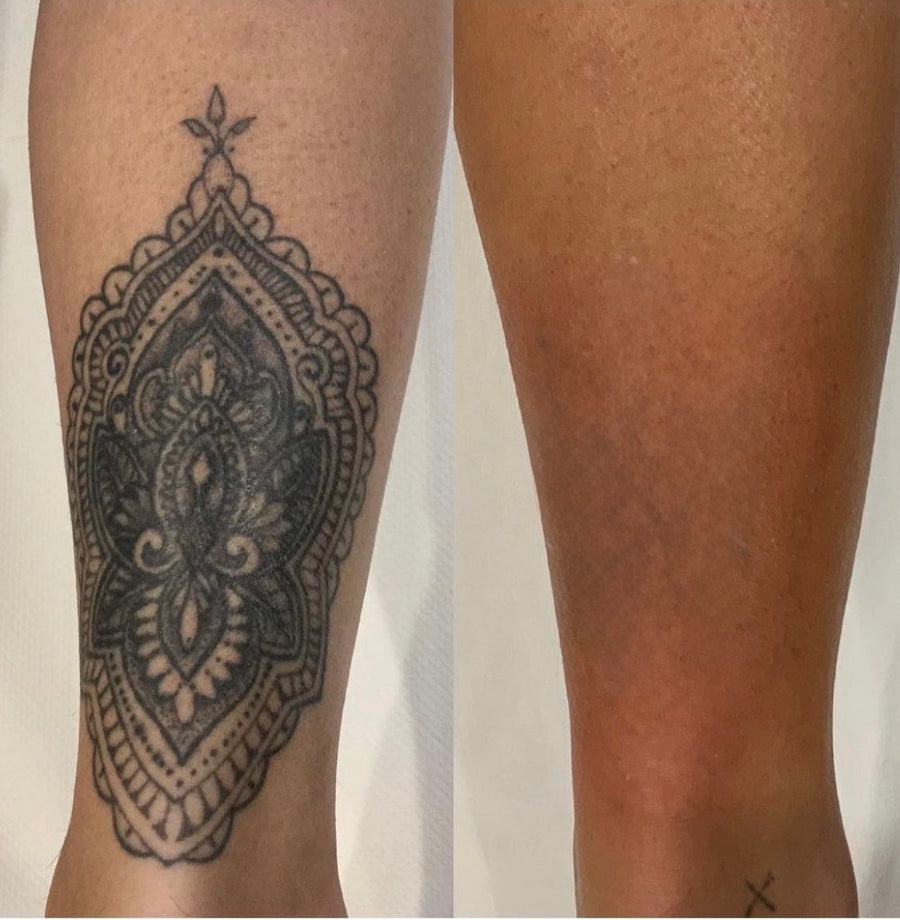 Pico laser tattoo removal