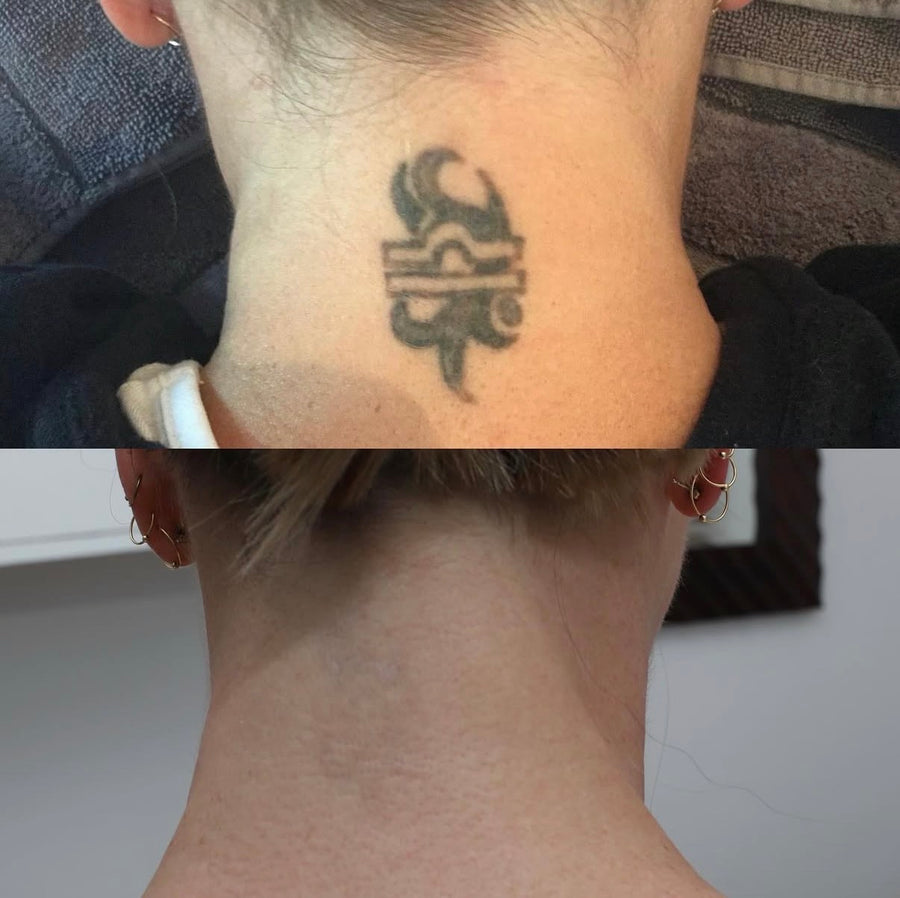 Pico laser tattoo removal