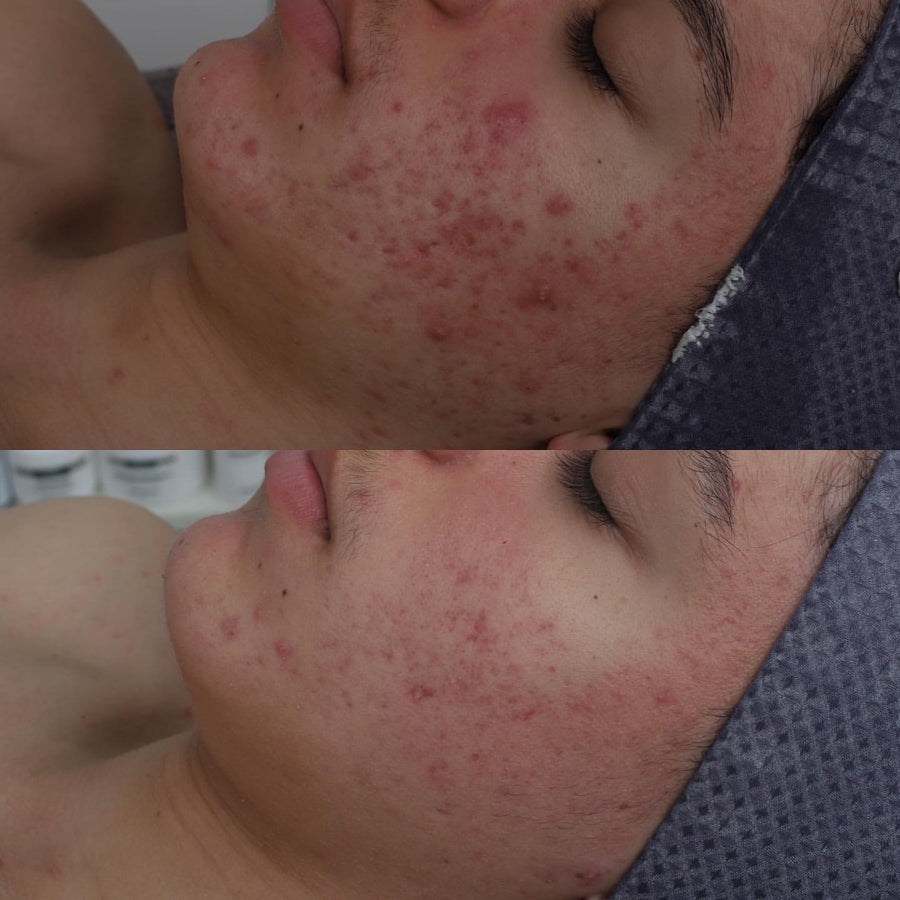 Skin Needling + Enzyme Therapy