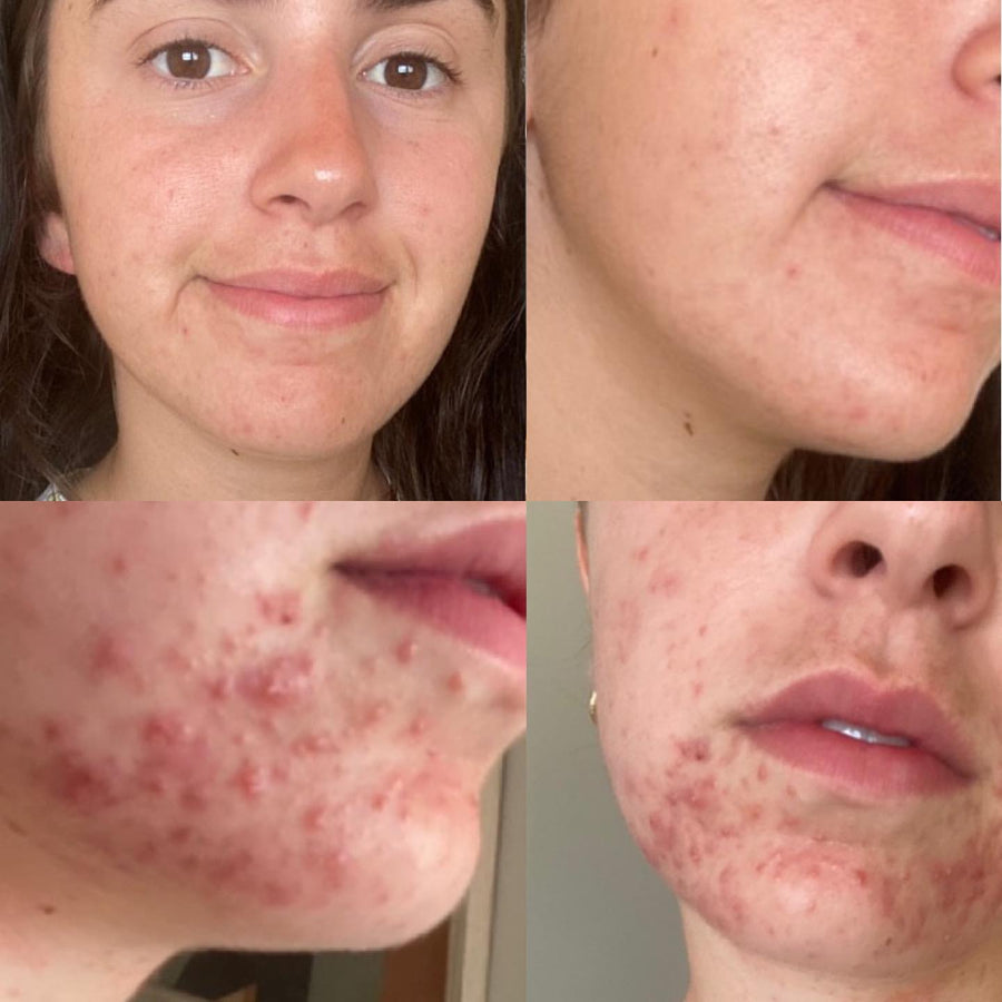 Skin Needling + Enzyme Therapy
