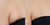 Ultraformer MPT HIFU for Body