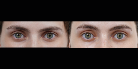 Ultraformer MPT HIFU