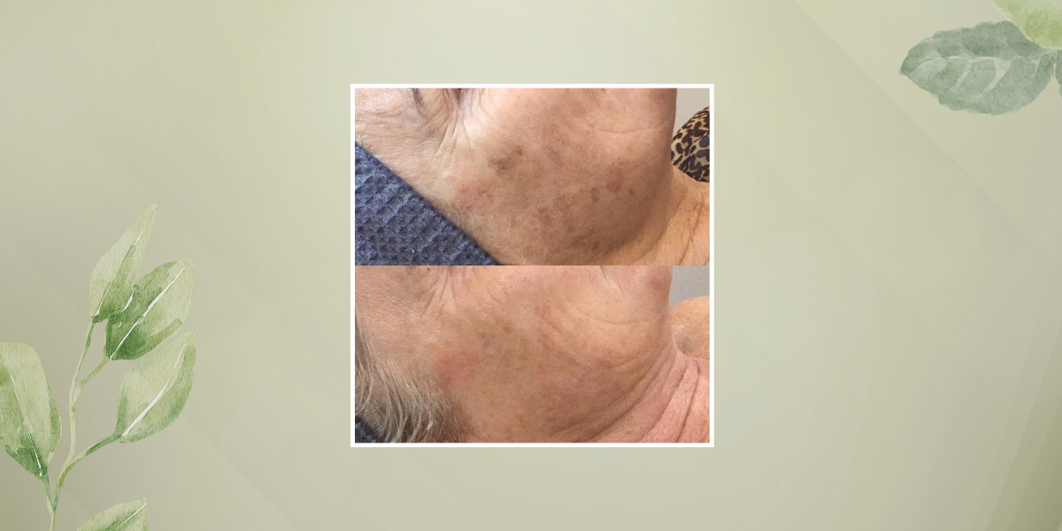 Radiance Revival - Pico Laser + Firming Peptide + LED