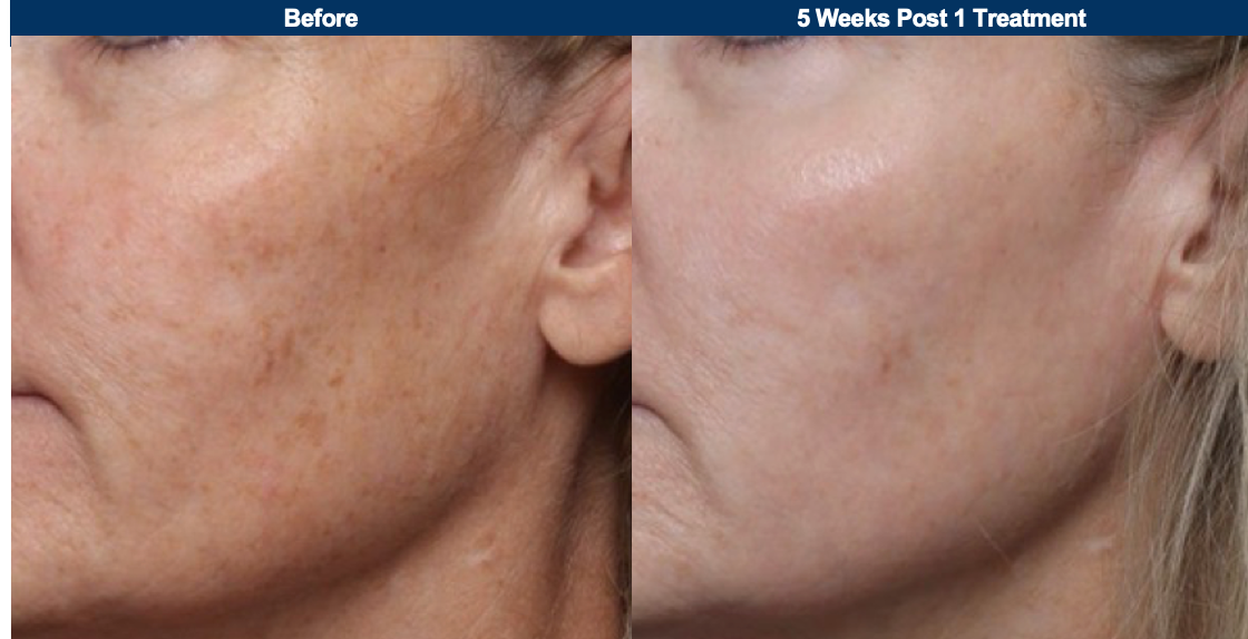Ultraclear® Laser