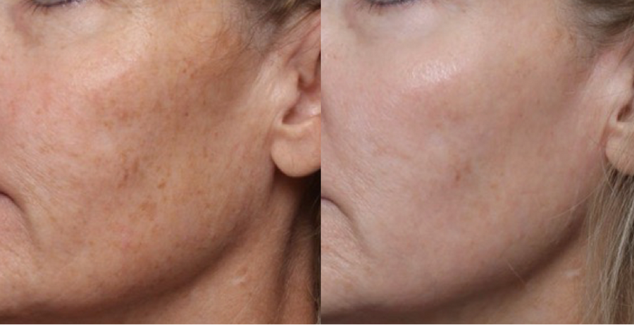 Before and after comparison of facial skin treatment showing reduced blemishes.