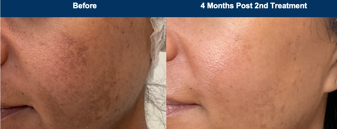 Ultraclear® Laser